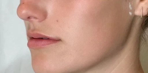 Baby Lips (Conservative Lip Treatment), before treatment
