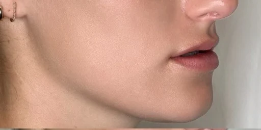 Baby Lips (Conservative Lip Treatment), before treatment