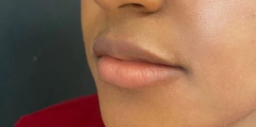 Baby Lips (Conservative Lip Treatment), before treatment