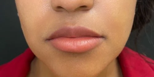 Baby Lips (Conservative Lip Treatment), before treatment