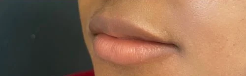 Baby Lips (Conservative Lip Treatment), before treatment