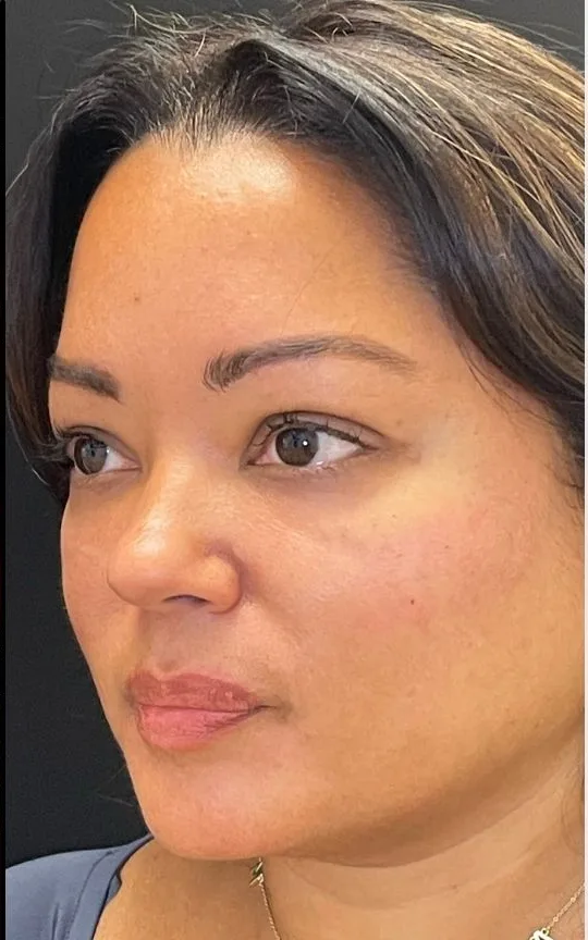 Cheek Filler, after treatment