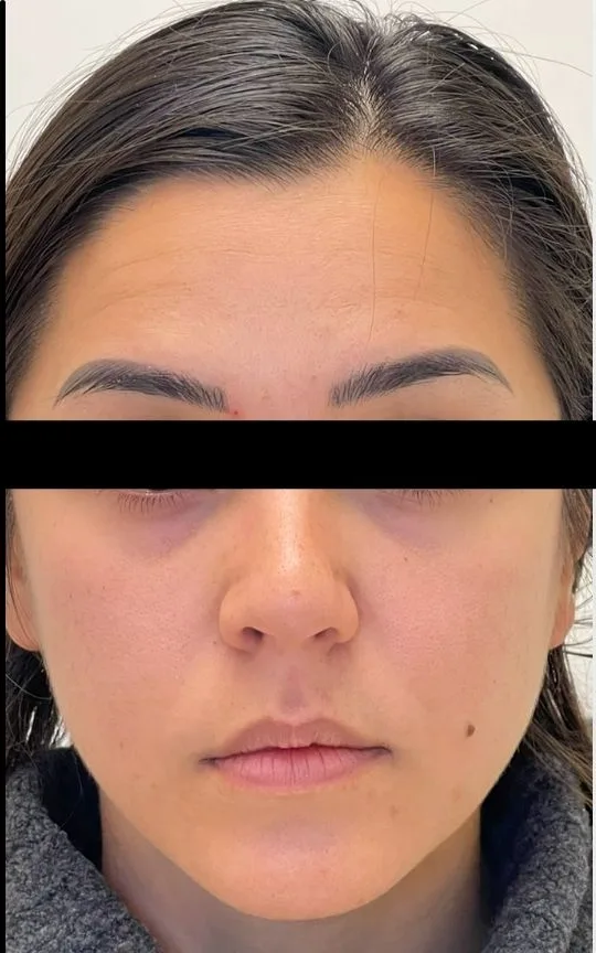 Botox and Dermal Filler, after treatment
