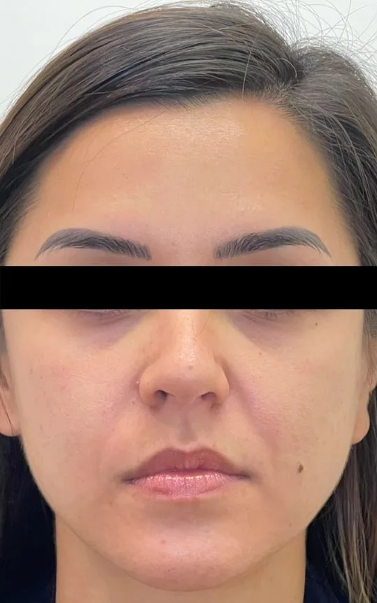 Botox and Dermal Filler, before treatment