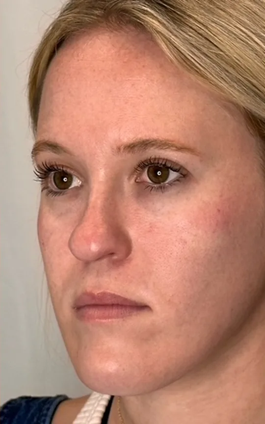 Cheek Lift, after treatment