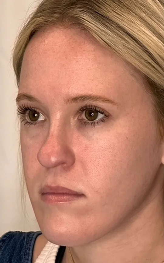 Cheek Lift, before treatment