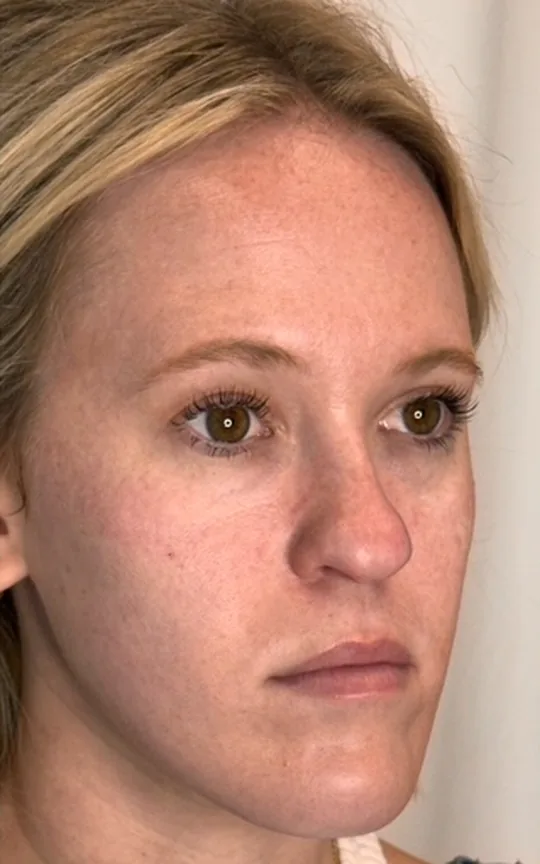 Cheek Lift, after treatment