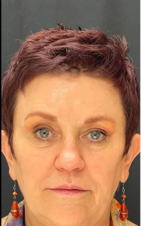 Botox and Dermal Filler, after treatment