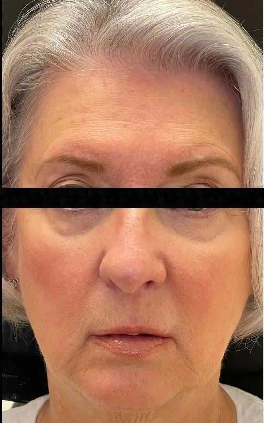 Dermal Filler, after treatment