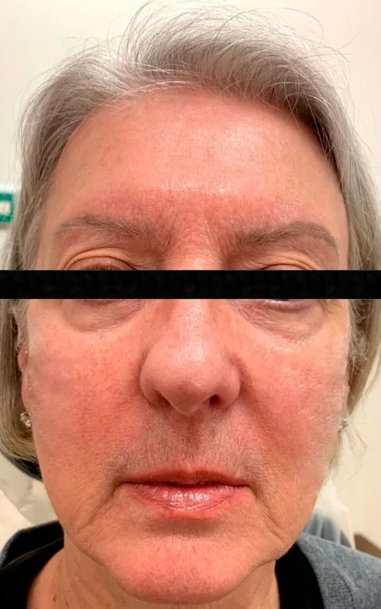 Dermal Filler, before treatment