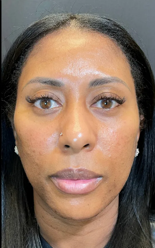 Cheeks, Chin, and Lips, after treatment
