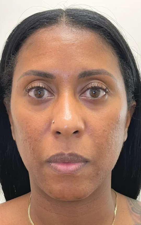 Cheeks, Chin, and Lips, before treatment