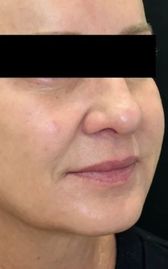 Nonsurgical Facelift, after treatment