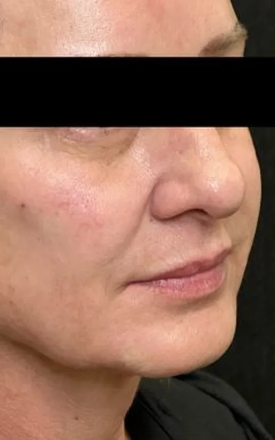 Nonsurgical Facelift, before treatment