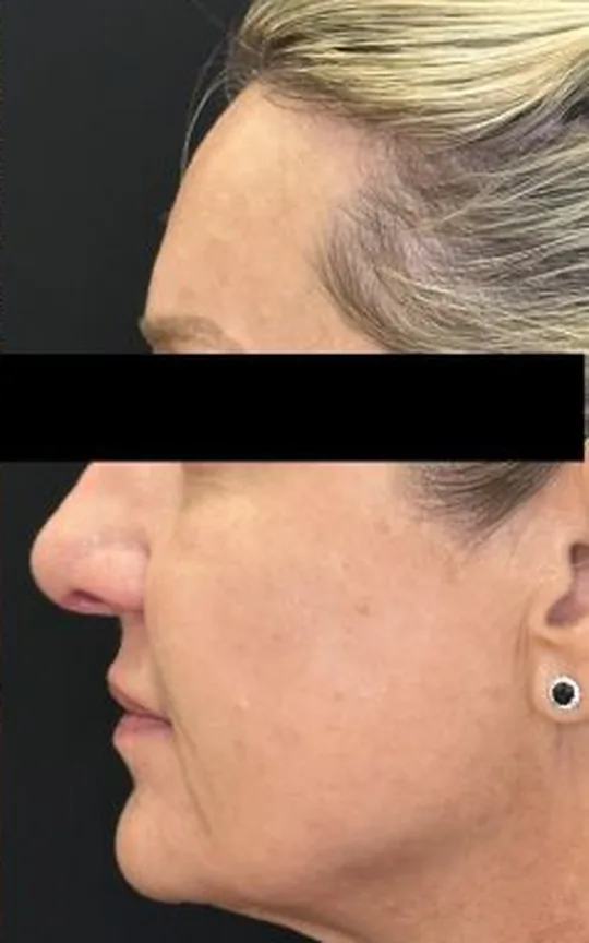Nonsurgical Facelift, after treatment