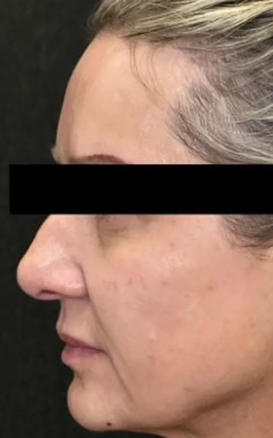 Nonsurgical Facelift, before treatment