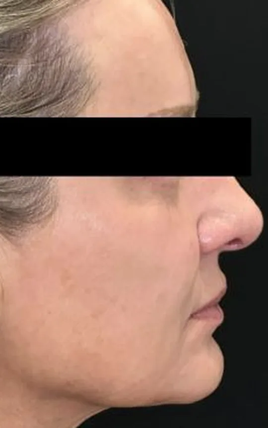 Nonsurgical Facelift, after treatment