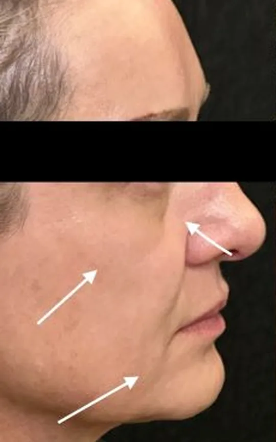 Nonsurgical Facelift, before treatment