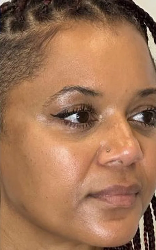 Nonsurgical Facelift, after treatment