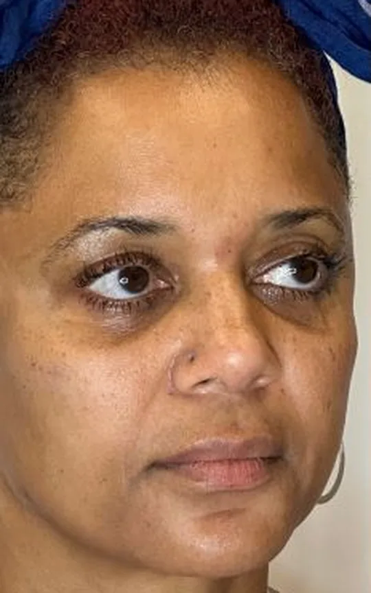 Nonsurgical Facelift, before treatment