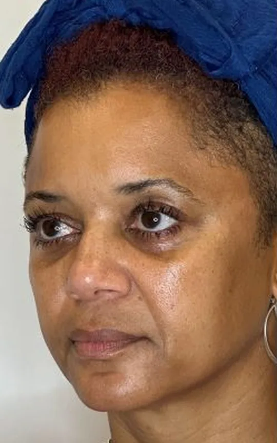 Nonsurgical Facelift, before treatment