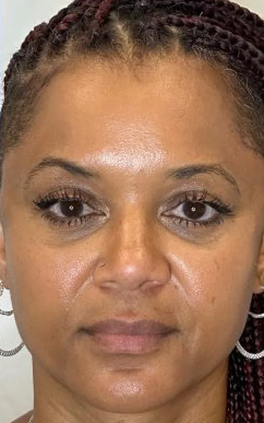 Nonsurgical Facelift, after treatment