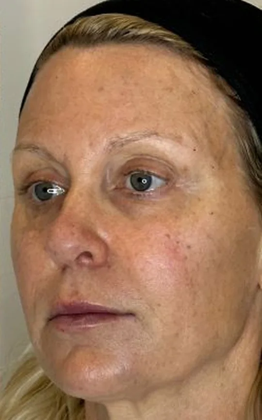Nonsurgical Facelift, after treatment