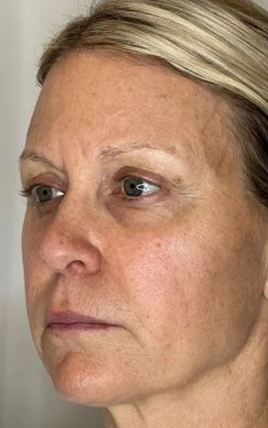 Nonsurgical Facelift, before treatment