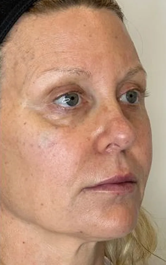Nonsurgical Facelift, after treatment