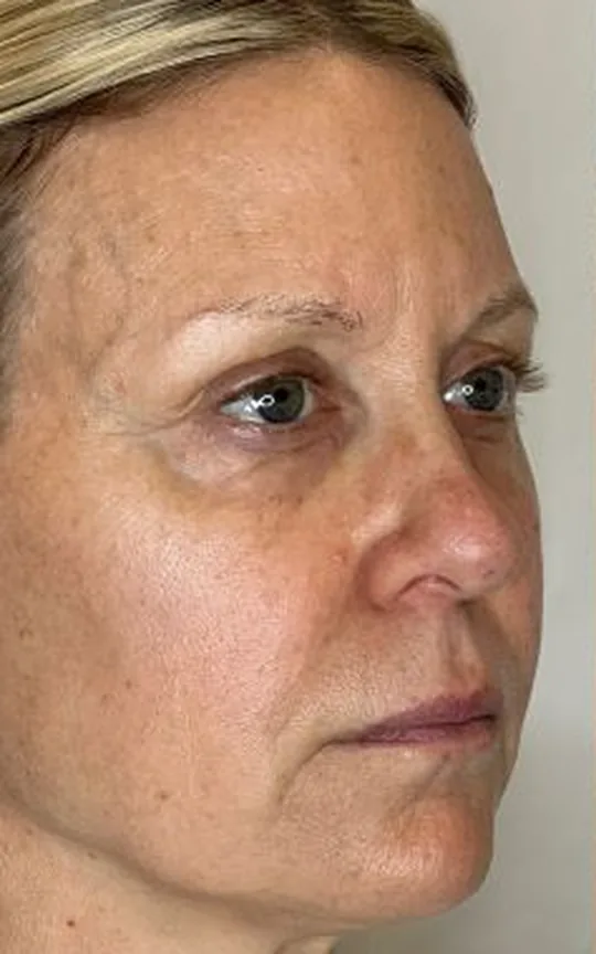 Nonsurgical Facelift, before treatment