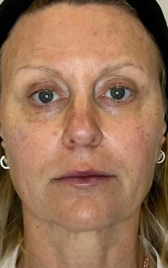 Nonsurgical Facelift, after treatment