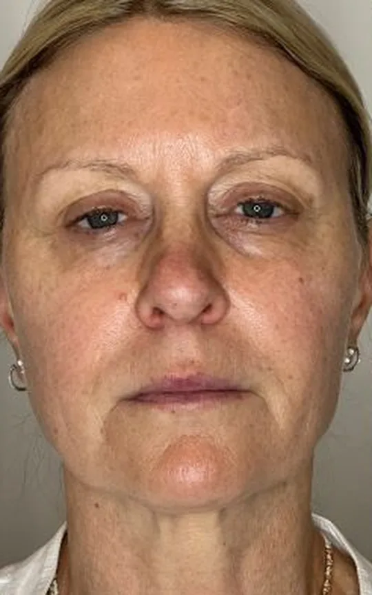 Nonsurgical Facelift, before treatment