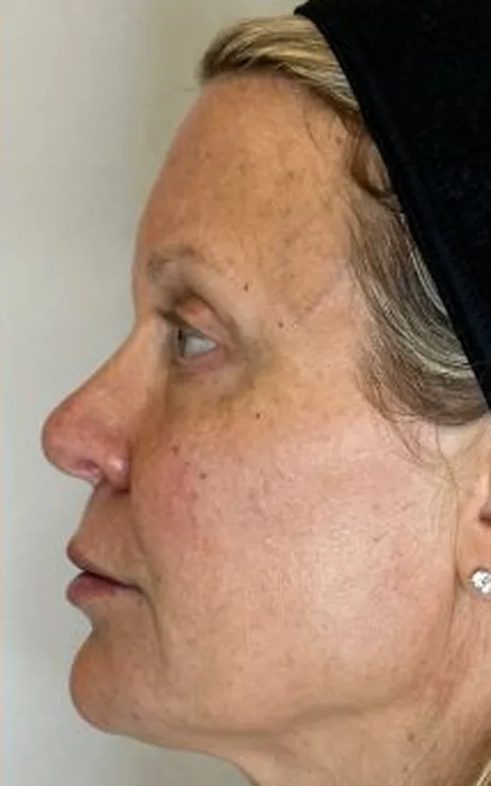 Nonsurgical Facelift, after treatment