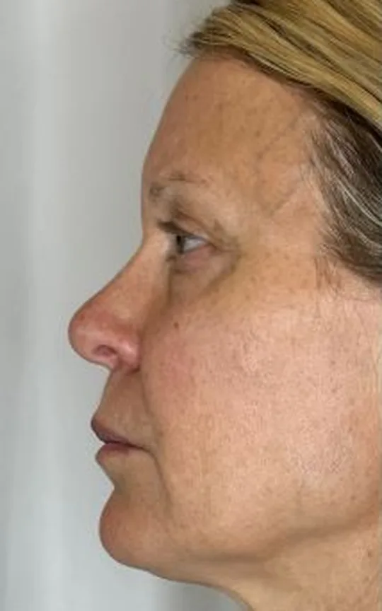 Nonsurgical Facelift, before treatment