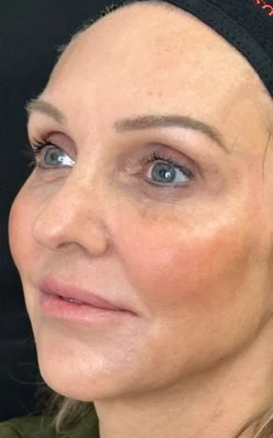 Nonsurgical Facelift, after treatment