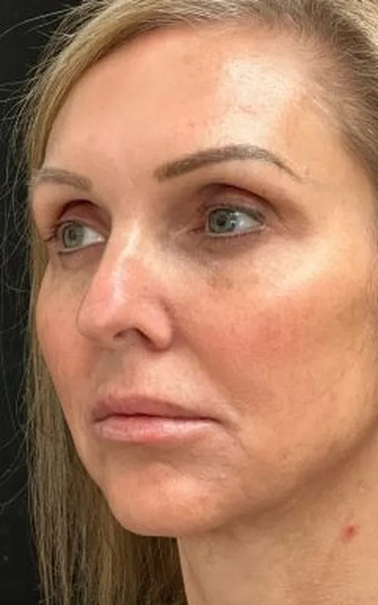 Nonsurgical Facelift, before treatment
