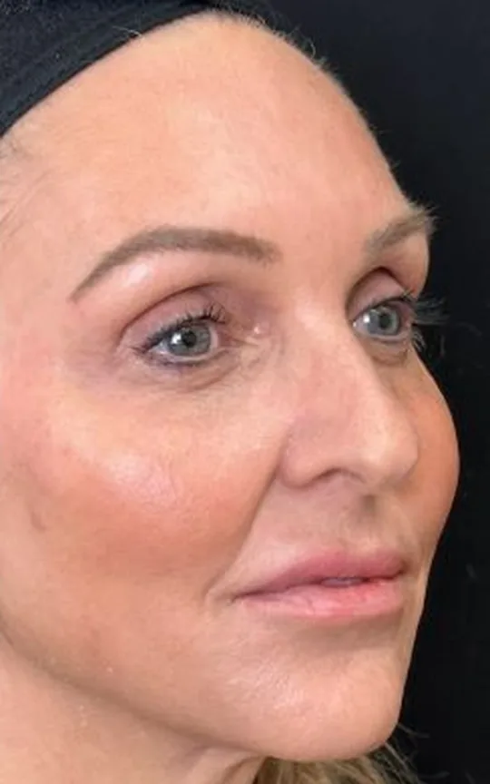 Nonsurgical Face Lift Using Dermal Fillers and Botulinum Toxins, after treatment
