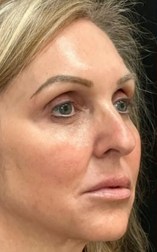 Nonsurgical Face Lift Using Dermal Fillers and Botulinum Toxins, before treatment