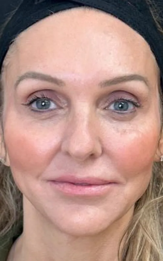 Nonsurgical Facial Lift Using Dermal Fillers, after treatment