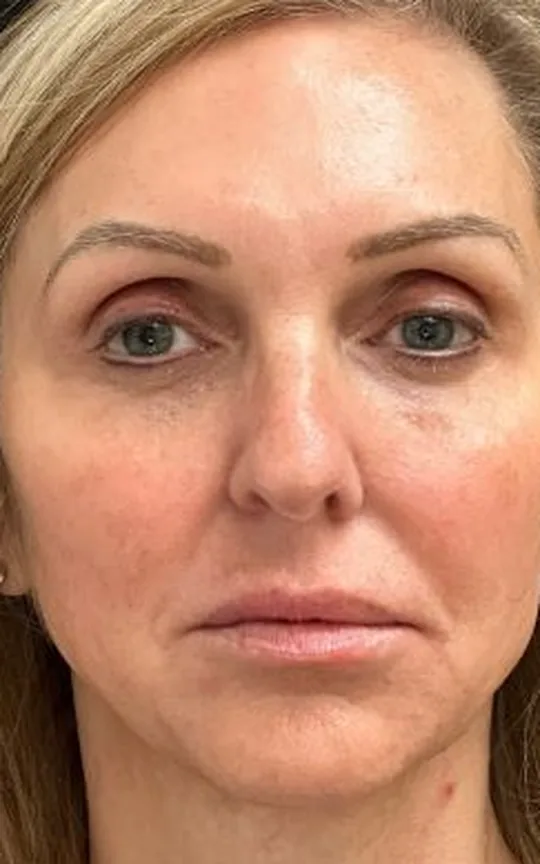Nonsurgical Facial Lift Using Dermal Fillers, before treatment