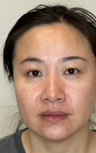 Facial Rejuvenation Using Dermal Fillers and Neurotoxins, after treatment
