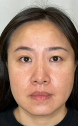 Facial Rejuvenation Using Dermal Fillers and Neurotoxins, before treatment