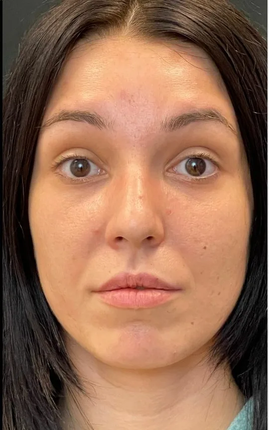 Botox Forehead, after treatment