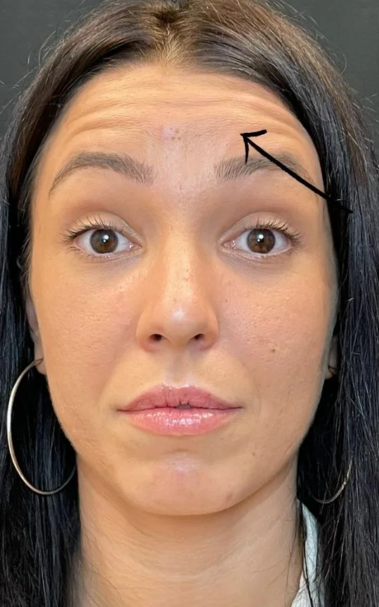 Botox Forehead, before treatment