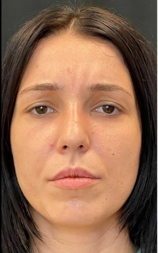 Botox Glabella, after treatment