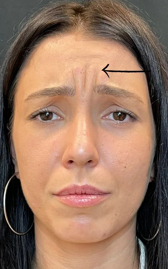 Botox Glabella, before treatment
