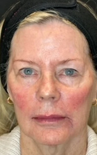 Full Facial Rejuvenation Using Dermal Fillers, after treatment