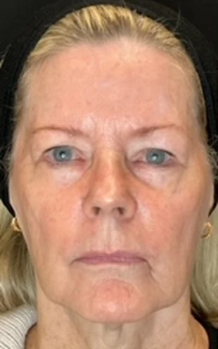 Full Facial Rejuvenation Using Dermal Fillers, before treatment