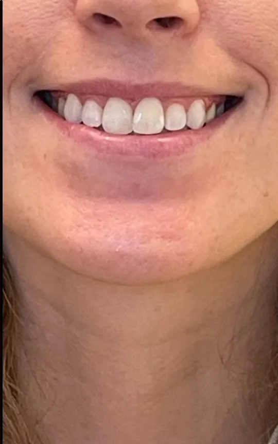 Botox Gummy Smile, after treatment