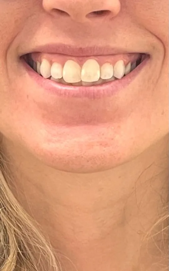 Botox Gummy Smile, before treatment